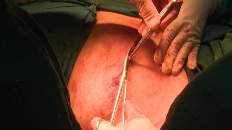 Las limitaciones futuras asociadas al vaciamiento axilar de ganglios en mujeres aquejadas de cáncer de mamas pudieran evitarse con esta técnica quirúrgica. Foto: Teleturquino