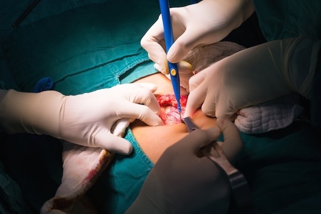  La extracción de la vesícula biliar, también conocida como colecistectomía, puede considerarse la segunda intervención quirúrgica más realizada en el mundo. Autor: Tomada de www.medlline.com 