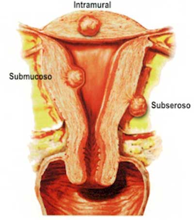 Fibromas del útero