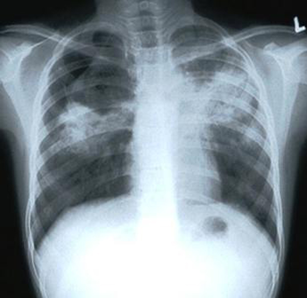 Desarrollan nuevo test para la predicción de la tuberculosis