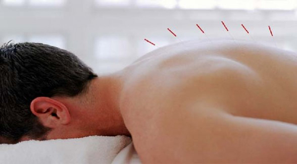 Acupuntura china, incorporada al Patrimonio Cultural de la Humanidad