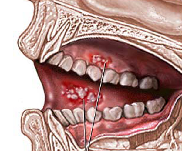 Cáncer bucal 