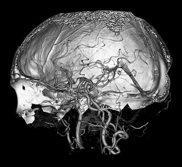 Intervención quirúrgica cerebral