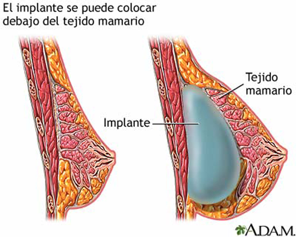 Mamoplastias estéticas