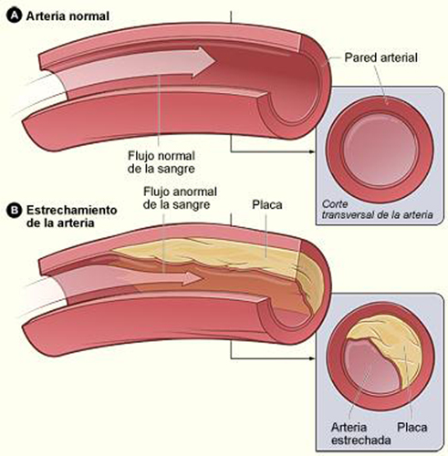 Arterias