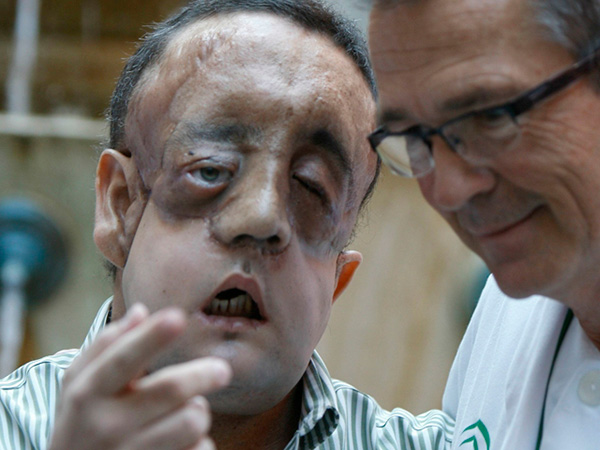 Trasplante de rostro