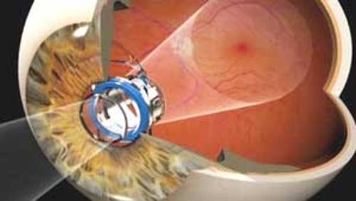 Implante ocular