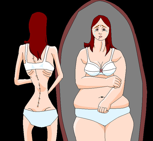 Anorexia y bulimia