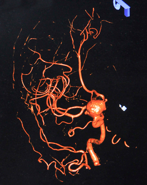 Aneurisma cerebral