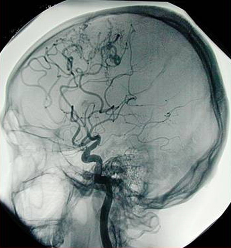 Angiografía del cerebro humano 