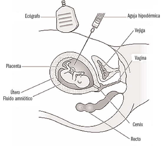 La amniocentesis