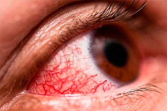 Conjuntivitis hemorrágica