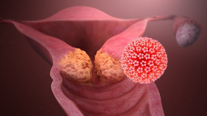 El papiloma es uno de los virus que más daña la salud sexual y reproductiva de las mujeres.