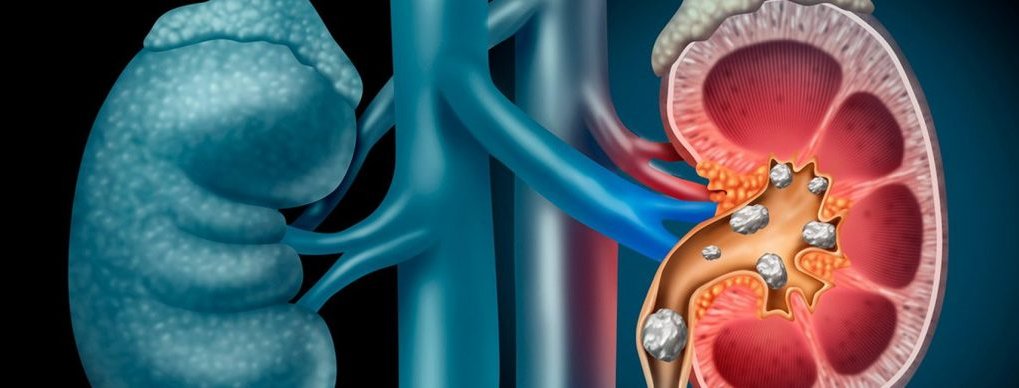 La litiasis renal