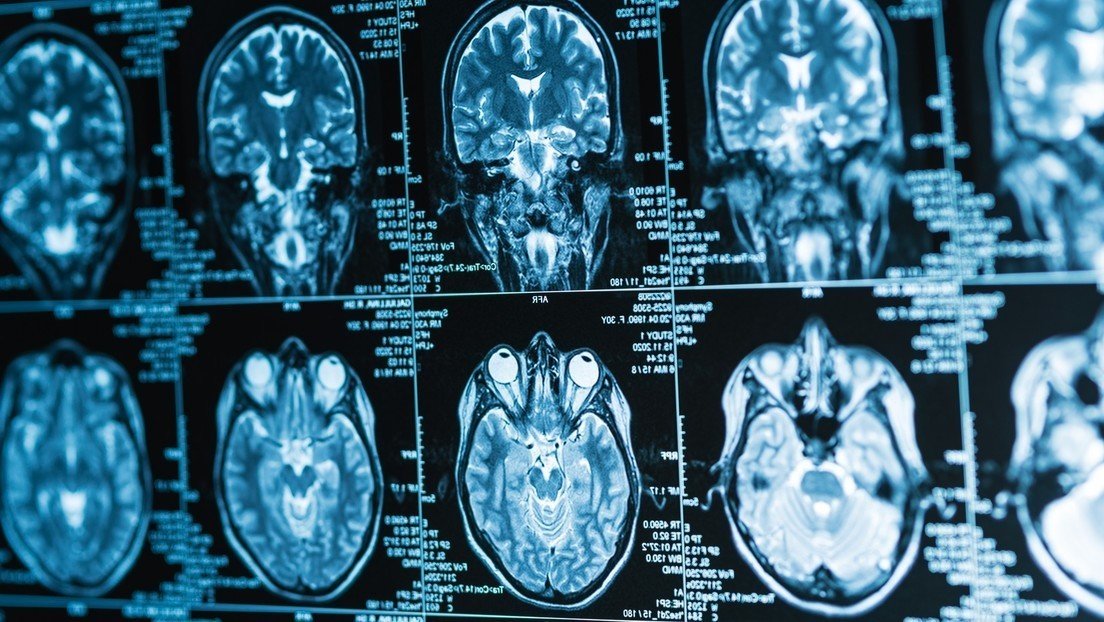 Implante cerebral convierte pensamientos en palabras