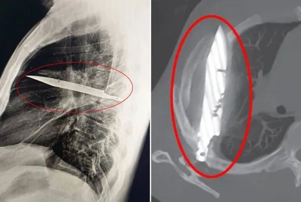 El cuchillo fue extraído cuidadosamente durante la cirugía junto con el tejido muerto y el pus