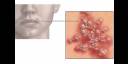 Virus del herpes