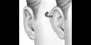 Otoplastia 