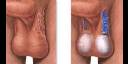 Varicoceles 