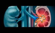 La litiasis renal