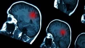 Fármacos hormonales podrían causar tumores cerebrales