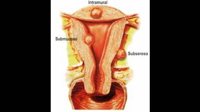 Fibromas del útero