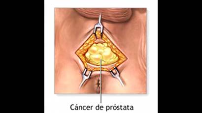 Cancer de Próstata