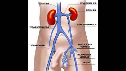 Varicocele