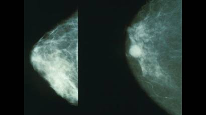 El cáncer de mama en Francia