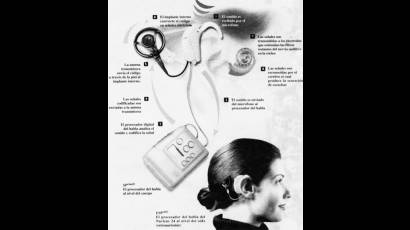 Implante Coclear