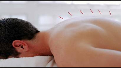 Acupuntura china, incorporada al Patrimonio Cultural de la Humanidad