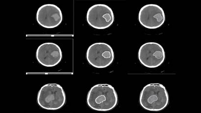 Hemorragia cerebral