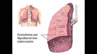 Tuberculosis