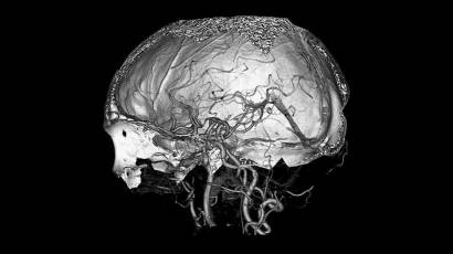 Intervención quirúrgica cerebral