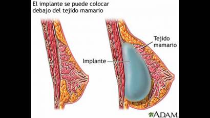 Mamoplastias estéticas