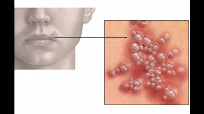 Virus del herpes
