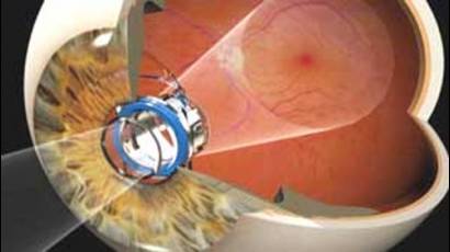 Implante ocular