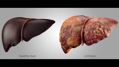 A la izquierda, hígado sano; a la derecha, cirrosis