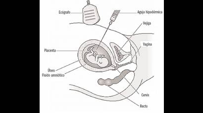 La amniocentesis