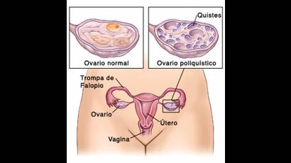 Acumulación de quistes en los ovarios