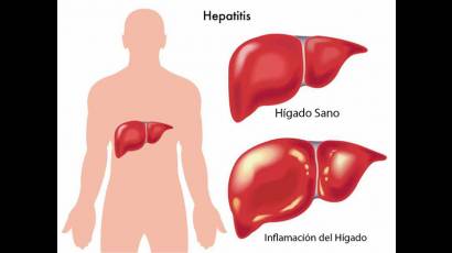 Hepatitis