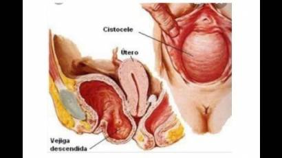 Descenso de la pared vaginal anterior por presión de la vejiga
