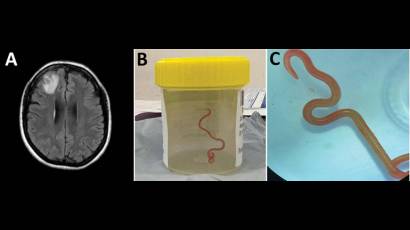 Un escáner cerebral y el nematodo extraído en un frasco de muestras. 
