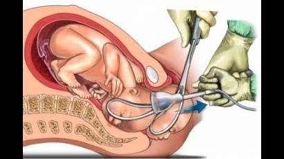 Forceps