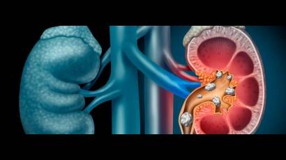 La litiasis renal