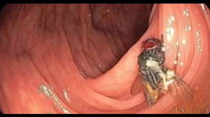 Un hombre fue a su consulta médica de rutina y encontraron una mosca viva en sus intestinos