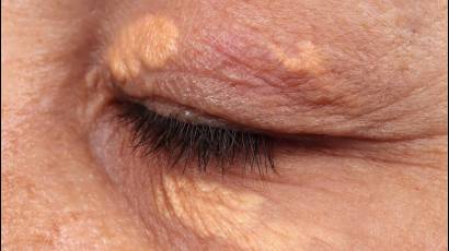 ¿Qué podrían decir las manchas alrededor de los ojos sobre tu salud?