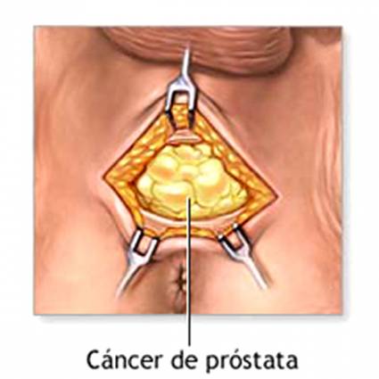 Cancer de Próstata