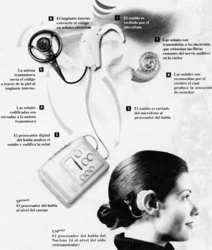 Implante Coclear