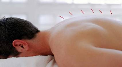 Acupuntura china, incorporada al Patrimonio Cultural de la Humanidad